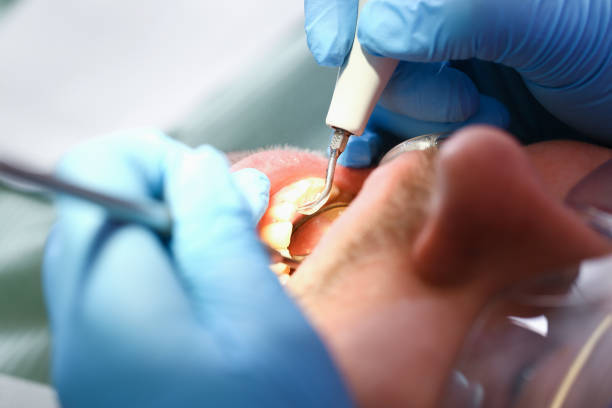 Best Emergency Tooth Extraction in Green, OH